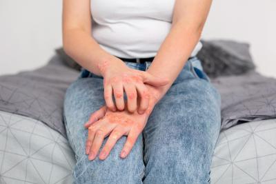 Zašto je psorijaza često teža kod žena - kako sebi možete da pomognete?